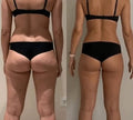 SONIQ - Ultrasoniq Body Toner & Cellulite Remover