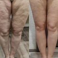 SONIQ - Ultrasonic Body Toner & Cellulite Remover